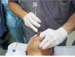 ¿Cuándo intubar un paciente durante la reanimación?