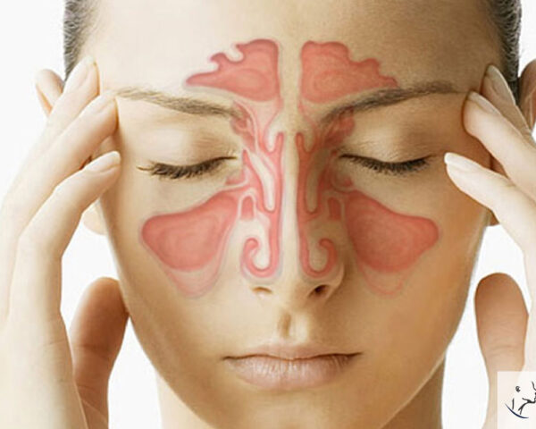 ¿Qué es la rinusinusitis bacteriana aguda?