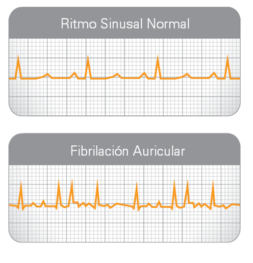 Tratamiento inicial de la fibrilación auricular en paciente hemodinámicamente inestable