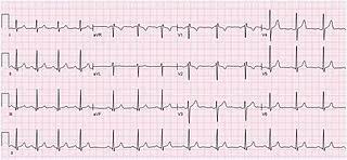 Características de la arritmia sinusal