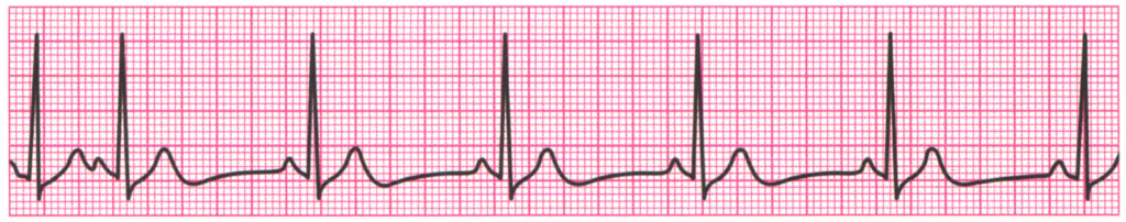 ¿Qué son las contracciones auriculares prematuras?