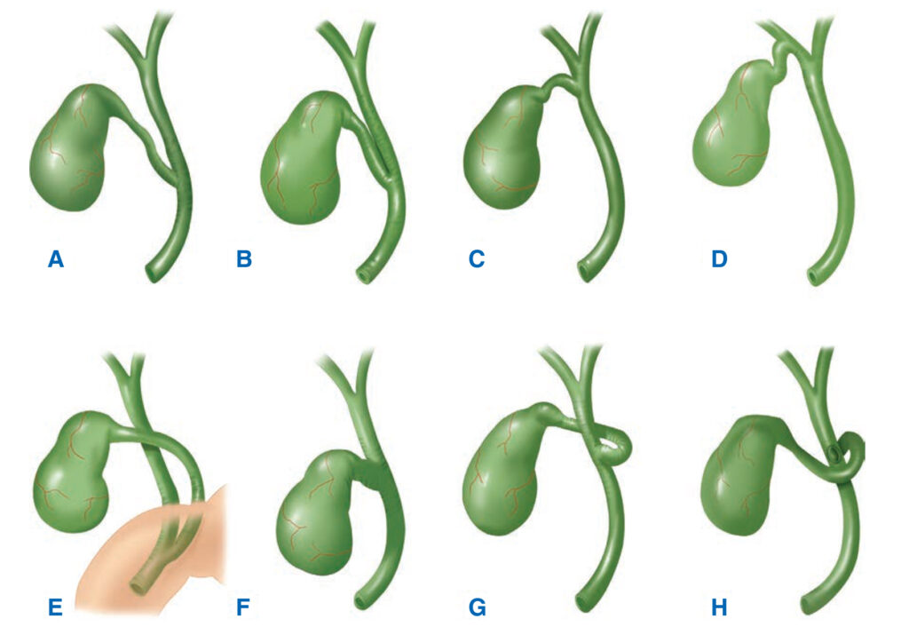 Variaciones del conducto cístico