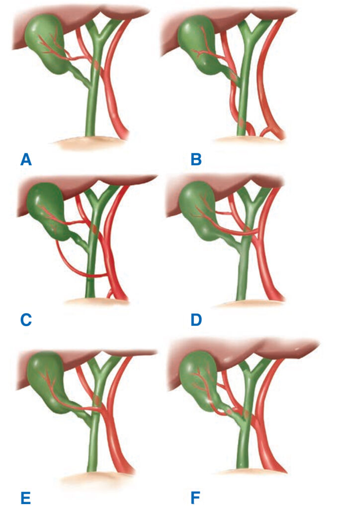 Variaciones en el riego arterial de la vesícula biliar