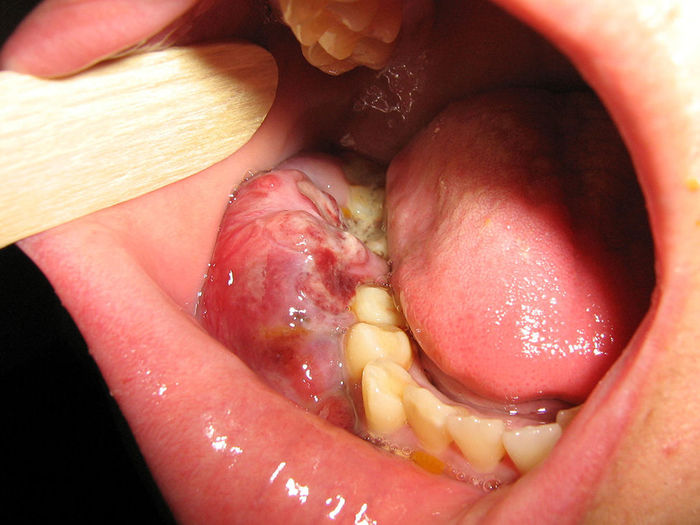 Formas del linfoma de Burkitt