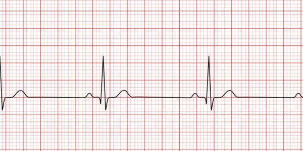 Ritmos sinusales anormales