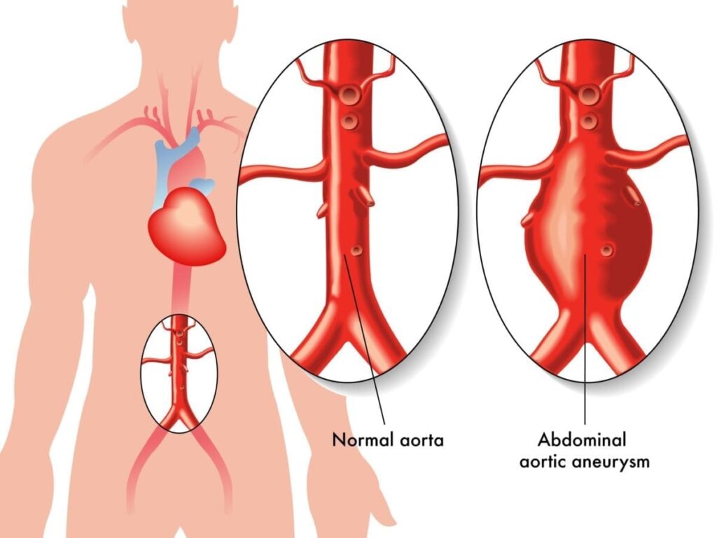 Detección de aneurisma de la aorta abdominal