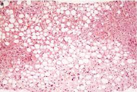 Características histológicas de la hepatitis alcohólica