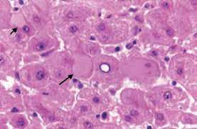 ¿Qué son los cuerpos de Mallory-Denk?