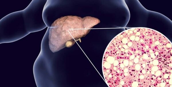 Influencia del alcohol en el metabolismo de los lípidos