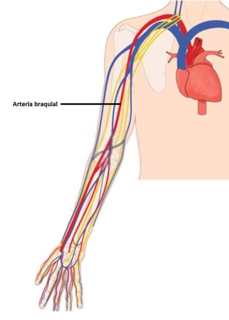 Punción de la arteria humeral