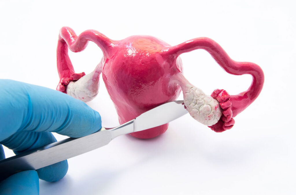 Trastornos benignos de ovario