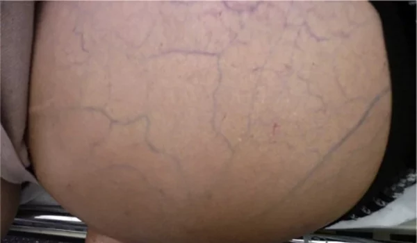 ¿Por que la cirrosis es una enfermedad grave?