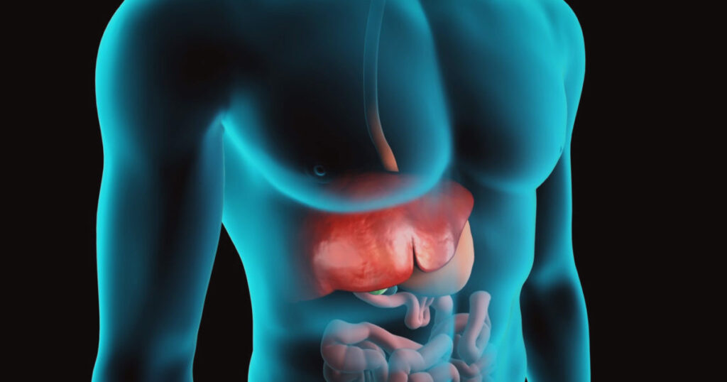 Manifestaciones de disfunción hepática en la cirrosis