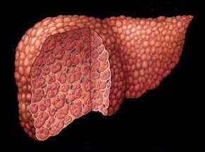 ¿Qué es la cirrosis hepática?