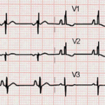 Manifestaciones electrocardiográficas en pacientes con defecto del septo auricular