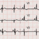 Manifestaciones electrocardiográficas en pacientes con defecto del septo auricular