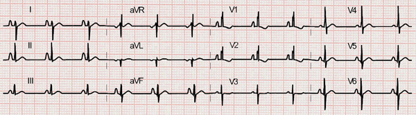 Manifestaciones electrocardiográficas en pacientes con defecto del septo auricular