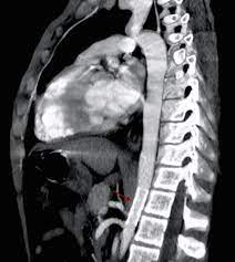 Estudios diagnósticos en la coartación aórtica