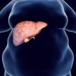 Factores de riesgo para hepatopatía grasa no alcohólica