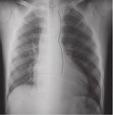 Hallazgos radiológicos en la coartación aórtica