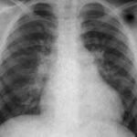 Radiografía en pacientes con defecto del septo auricular