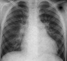 Radiografía en pacientes con defecto del septo auricular