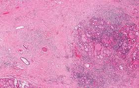 ¿Qué es la tiroiditis de Riedel?