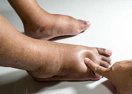 Causas de edema agudo o crónico de las extremidades