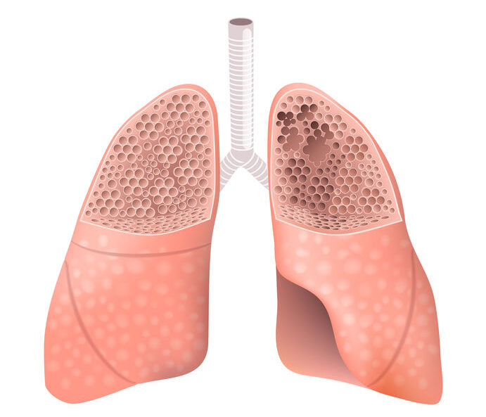 ¿Qué es el enfisema pulmonar?