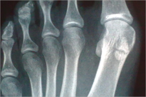 ¿Por qué varía el número de huesos en los humanos?