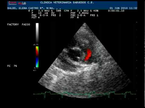 ¿Cuál es el estudio diagnóstico más preciso para la estenosis de la válvula pulmonar?