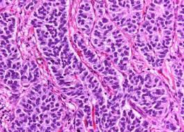 Tumores neuroendocrinos gastroenteropancreáticos