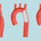 Tratamiento de la coartación aórtica