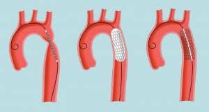 Tratamiento de la coartación aórtica