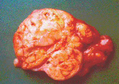 ¿Qué es un glucagonoma?