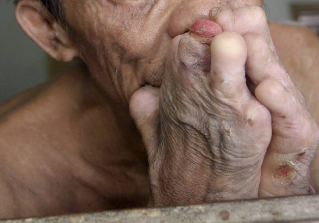 Manifestaciones clínicas de la lepra