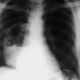Características de un absceso pulmonar