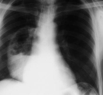 Características de un absceso pulmonar