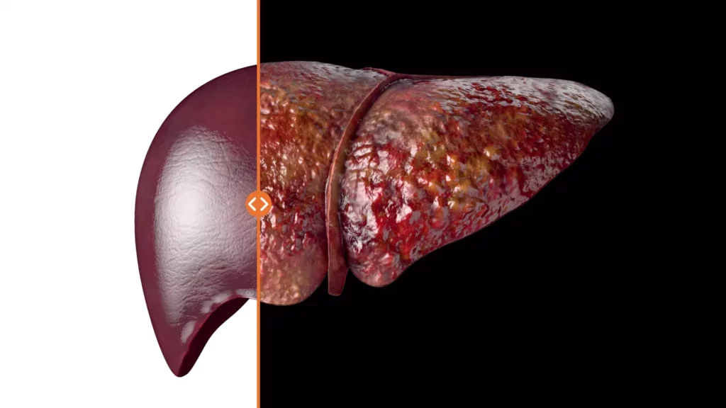 ¿La cirrosis es una enfermedad irreversible?
