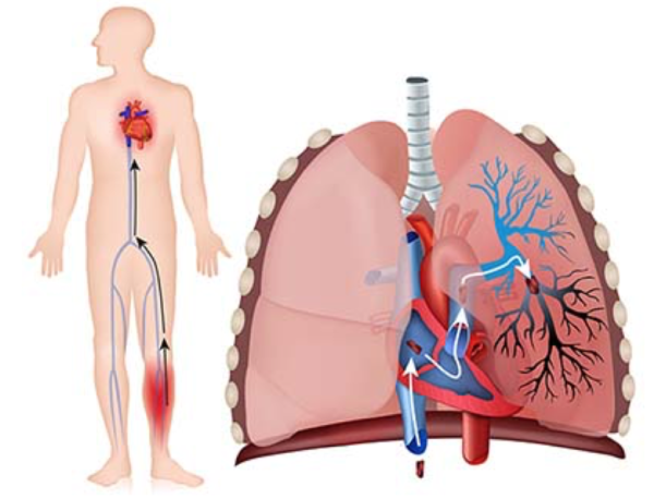 Fisiopatología de la tromboembolia pulmonar
