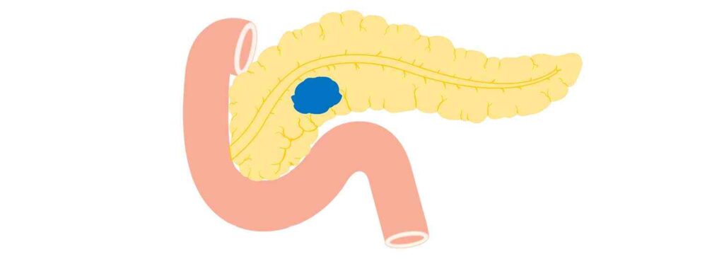 ¿Qué son los tumores neuroendócrinos no funcionales?