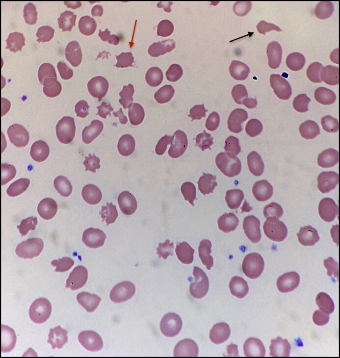 ¿Qué es el síndrome de Zieve?