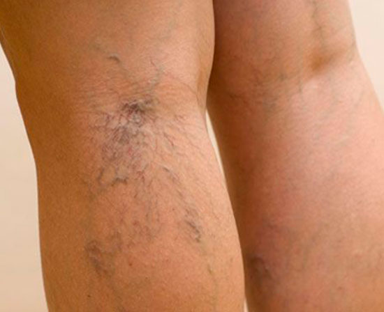 ¿Qué son las várices?