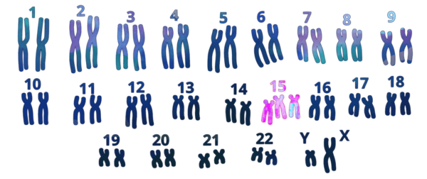 ¿Qué es una trisomía?