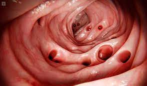 La Enfermedad Diverticular, también conocida como Diverticulitis, es un término clínico que se utiliza para describir la presencia de divertículos sintomáticos en el colon o intestino grueso. Para entender este término en detalle, es necesario desglosar varios conceptos: qué son los divertículos, cómo se forman, qué es la diverticulosis y cómo evoluciona hacia la diverticulitis. Divertículos: Los divertículos son pequeñas bolsas o sacos que se forman en la pared del colon, principalmente en áreas donde los músculos de la pared del colon son más débiles. Estas bolsas pueden variar en tamaño, desde pequeñas protuberancias hasta sacos más grandes. Diverticulosis: La diverticulosis es la condición en la que hay una presencia de divertículos en la pared del colon, pero en principio no están inflamados ni causan síntomas. Es una condición bastante común, especialmente en personas mayores. Los divertículos se forman debido a la presión que ejerce la materia fecal sobre las áreas más débiles de la pared del colon a lo largo del tiempo. La diverticulosis en sí misma generalmente no causa problemas y puede pasar desapercibida. Diverticulitis: La diverticulitis ocurre cuando uno o más de estos divertículos se inflaman o infectan. Esto puede ocurrir debido a la acumulación de materia fecal en los sacos, lo que puede llevar al desarrollo de infecciones bacterianas. Los síntomas de la diverticulitis pueden variar desde dolor abdominal intenso, sensibilidad en el área afectada, fiebre, escalofríos, náuseas y cambios en los hábitos intestinales, como diarrea o estreñimiento. Enfermedad Diverticular: Este término se usa cuando los divertículos en el colon se vuelven sintomáticos y causan problemas de salud. La enfermedad diverticular implica la presencia de diverticulitis, donde los síntomas se vuelven evidentes y la inflamación en el colon puede llevar a complicaciones más graves, como abscesos, perforaciones en la pared del colon o incluso peritonitis (infección en el abdomen). Es importante tratar adecuadamente la diverticulitis para prevenir estas complicaciones. La enfermedad diverticular puede requerir tratamiento médico, que generalmente incluye antibióticos para tratar la infección y medidas para aliviar los síntomas, como cambios en la dieta para reducir la presión sobre el colon. En algunos casos graves, puede ser necesaria la hospitalización y, en casos extremos, la cirugía para extirpar la parte afectada del colon.