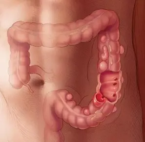 ¿Que es la diverticulosis?