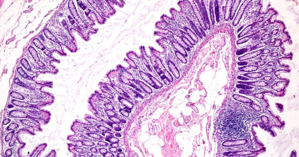 Divertículos colónicos falsos