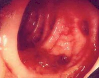 Hemorragia diverticular