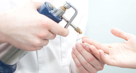 Indicaciones de la criocirugía