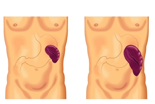 Causas comunes de esplenomegalia
